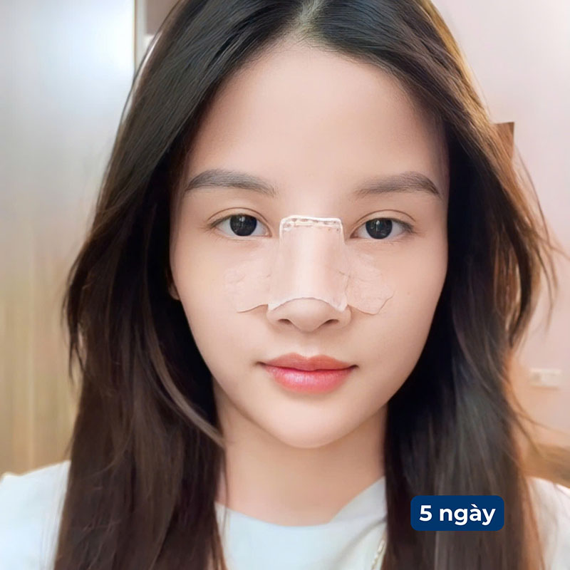 Mũi sau 5 ngày chưa tháo nẹp nhưng không còn căng tức