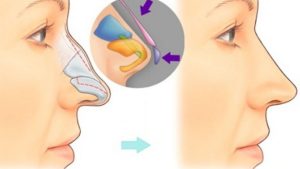 Nâng mũi bán cấu trúc – Giải pháp cho dáng mũi đẹp tự nhiên