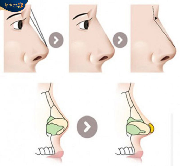 Nâng mũi bán cấu trúc phù hợp với những trường hợp ít khuyết điểm