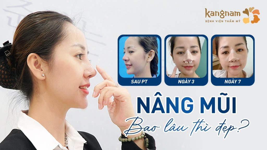 Nâng mũi bao lâu thì đẹp và ổn định