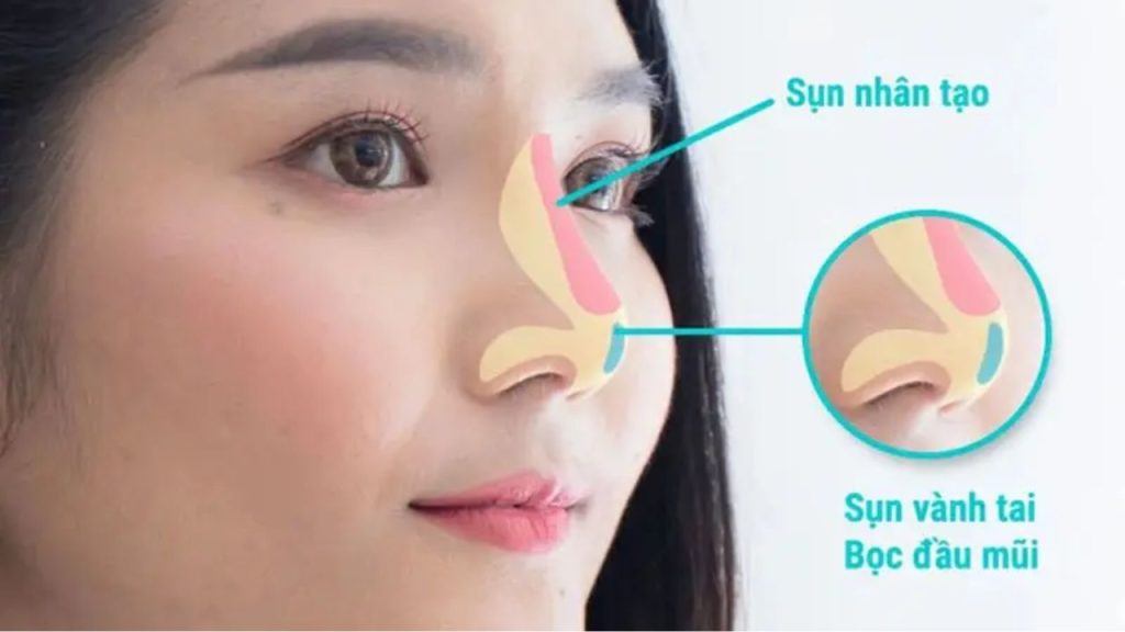 Nâng mũi bọc sụn là gì? phù hợp với ai, bao lâu thì đẹp