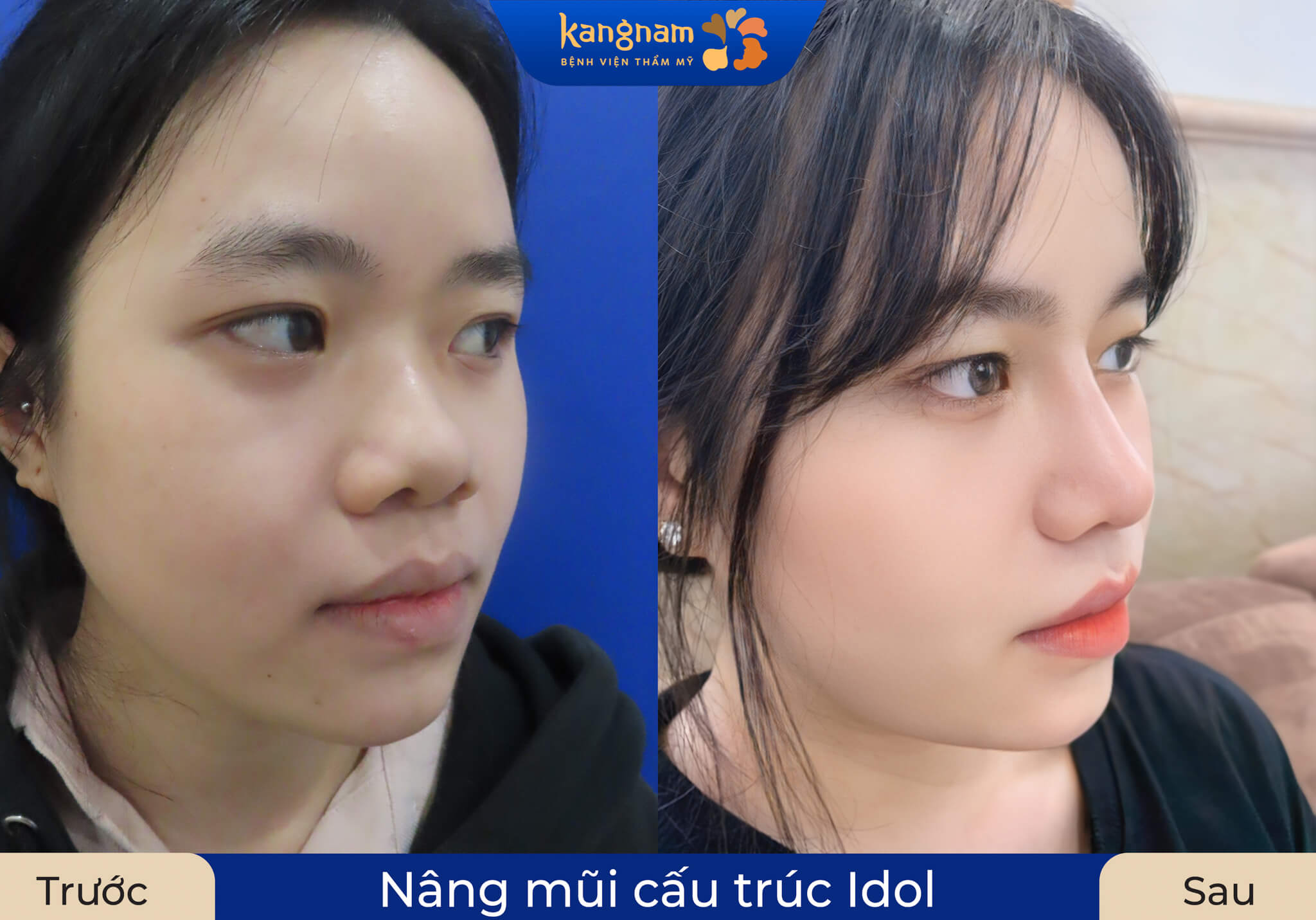 Góc nghiêng mềm mại, sống mũi cao nhưng vẫn giữ vẻ tự nhiên