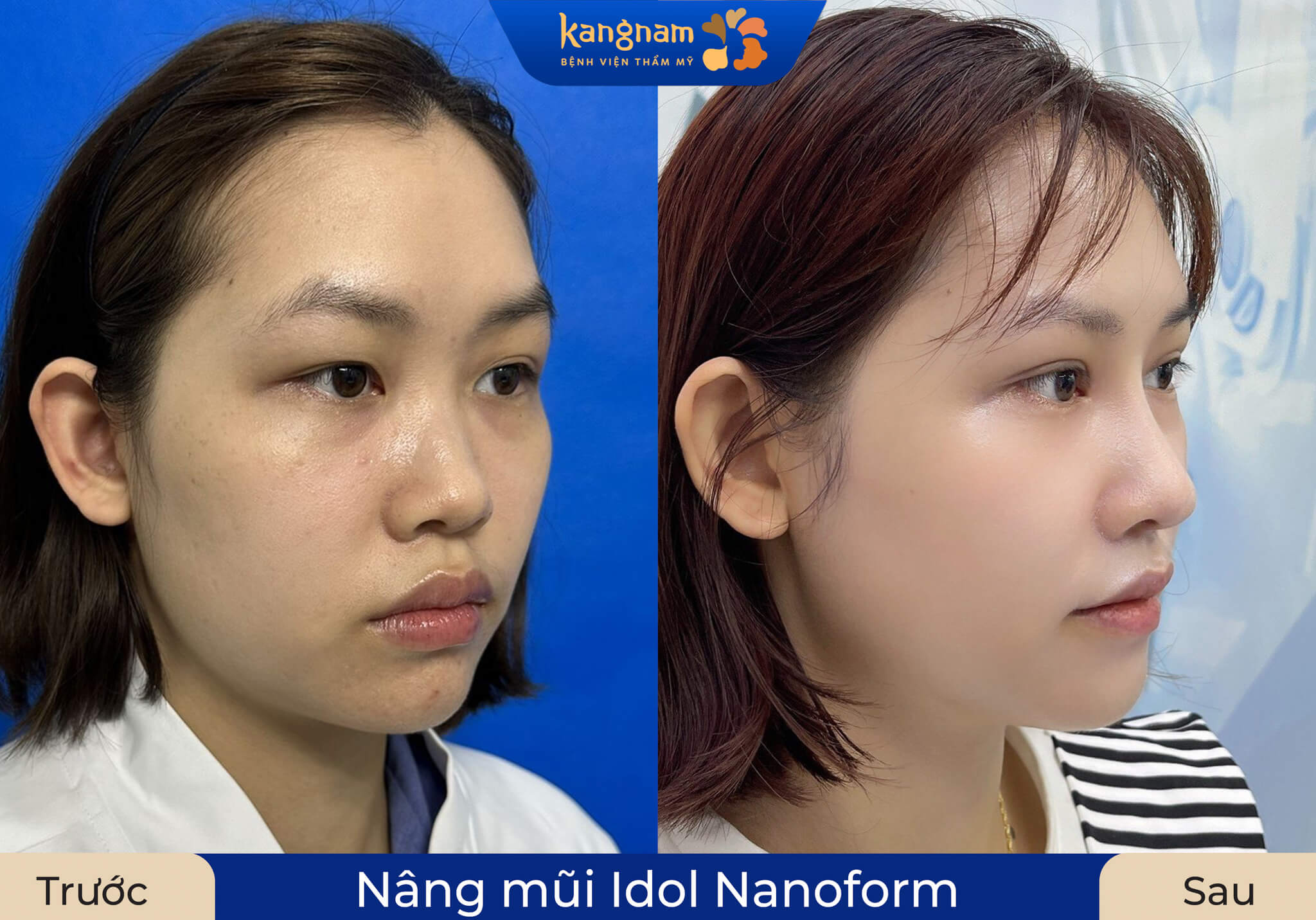Dáng mũi thanh thoát, tự nhiên rõ nét sau 1 tháng