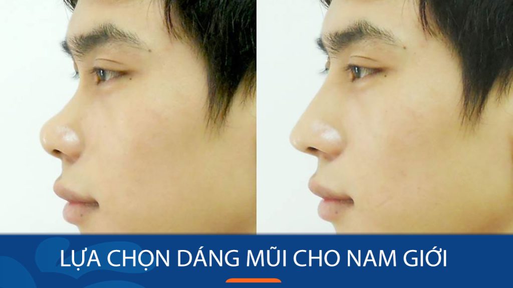 Dáng mũi phù hợp với nam giới – Bí quyết chọn dáng mũi thu hút