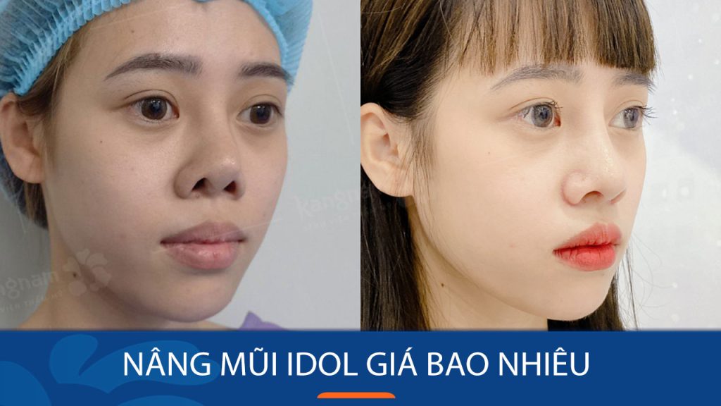 Nâng mũi Idol giá bao nhiêu? Bảng giá mới nhất
