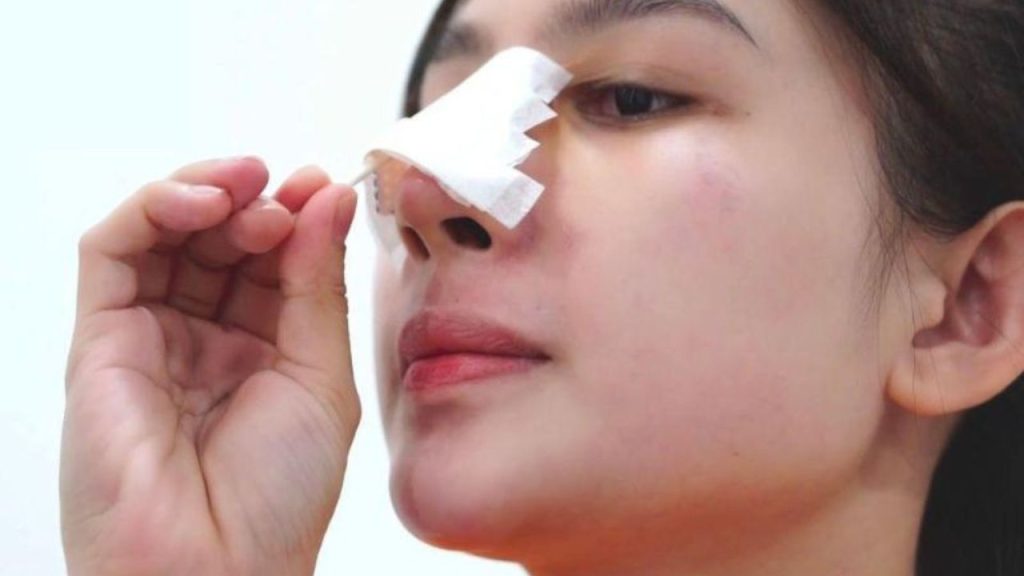 Nâng Mũi Cấu Trúc Idol Bao Lâu Tháo Nẹp? Giải Đáp Chi Tiết