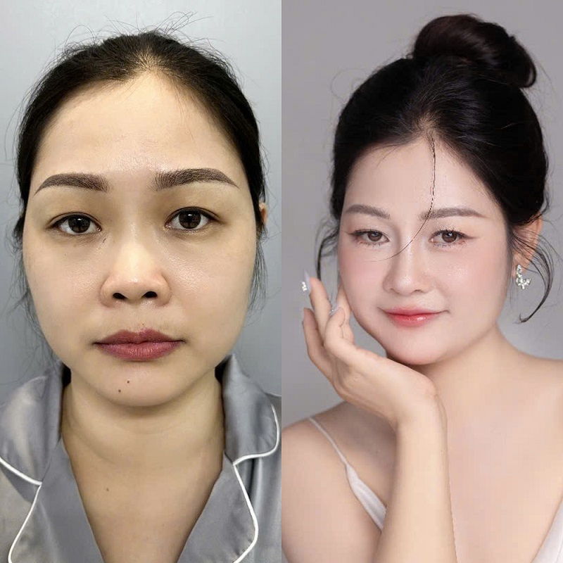 Tránh tiếp xúc với bụi bẩn hoặc môi trường ô nhiễm trong vòng vài tuần sau khi tháo nẹp