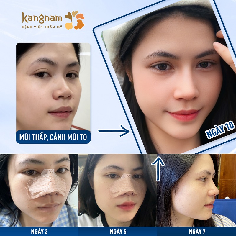 Khách hàng có thể tháo nẹp bên ngoài mũi sau khoảng từ 7 ngày