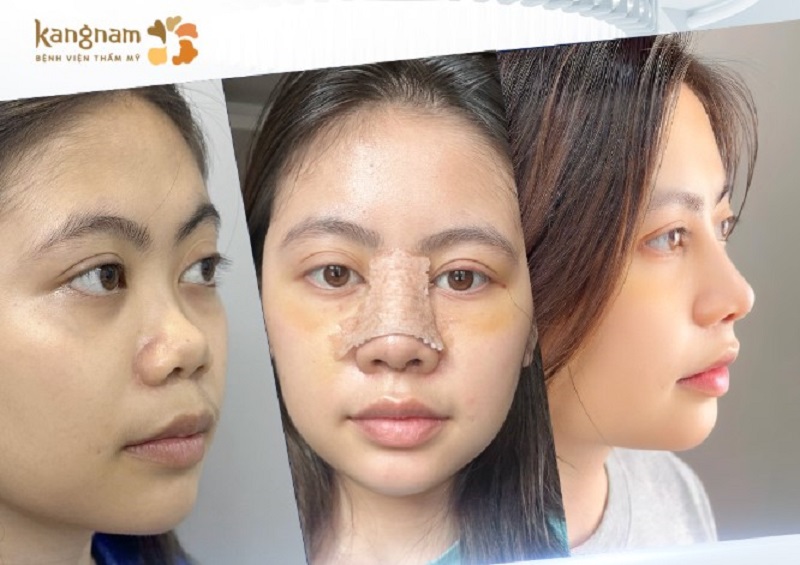 Việc đeo nẹp sau khi nâng mũi là vô cùng cần thiết để cố định trục mũi