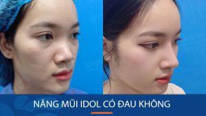 Nâng mũi Idol có đau không? Giải đáp thắc mắc từ A đến Z