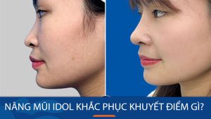 Mũi thấp tẹt, ngắn hếch, mũi ngắn có làm được mũi Idol không? Kangnam giải đáp