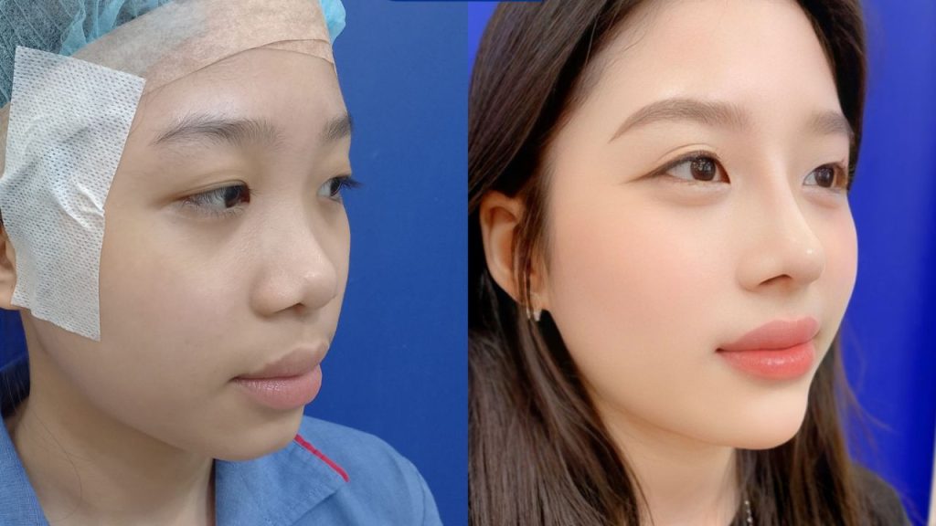 Nâng mũi cấu trúc Idol: Bí quyết sở hữu dáng mũi hoàn hảo như idol