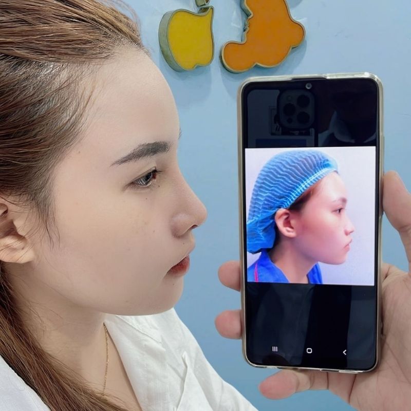 Sống mũi cao tự nhiên, thanh thoát