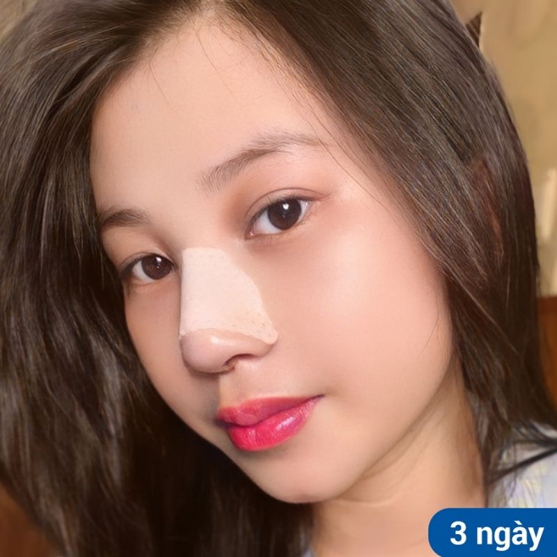 Nâng mũi cấu trúc cần thời gian để mô thích nghi