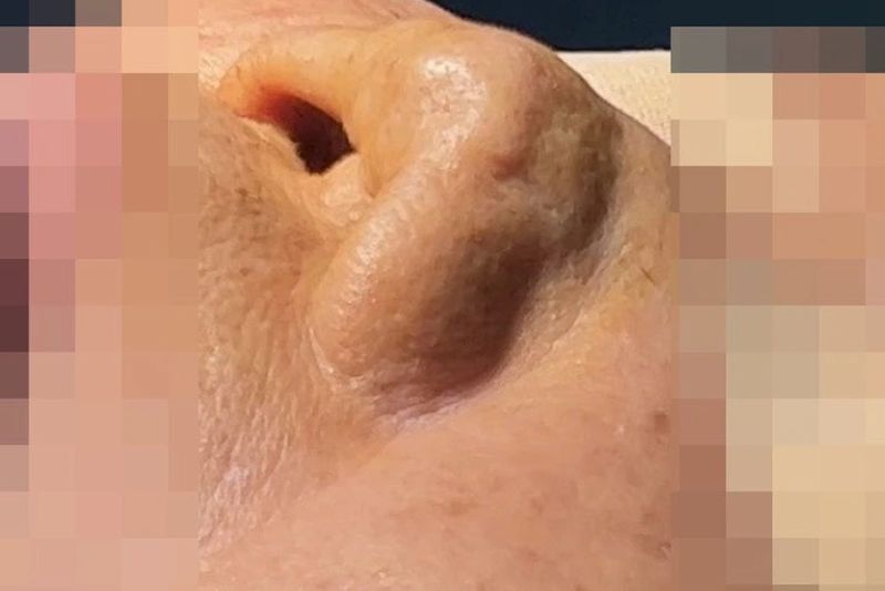 Mũi biến dạng do không hợp sụn