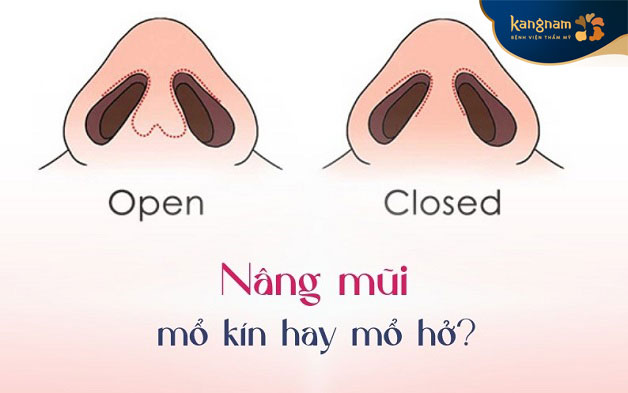 Phương pháp nâng mũi kín và nâng mũi hở có sự khác biệt