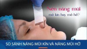 So sánh sự khác biệt giữa phương pháp nâng mũi hở và nâng mũi kín