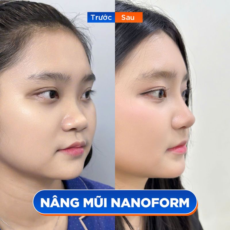 Thiế kế dáng mũi chuẩn tỷ lệ vàng, loại bỏ các khuyết điểm vùng mũi