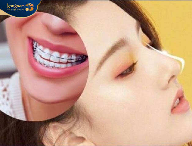 Niềng răng bằng mắc cài sứ sau nâng mũi