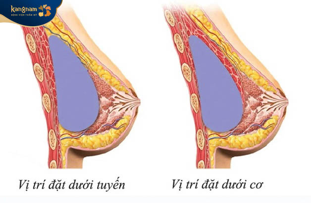 Đặt túi ngực dưới tuyến vú hoặc dưới cơ ngực