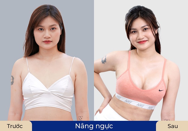 Khách hàng Chi Đỡi sau nâng ngực sở hữu vòng 1 to tròn, cân đối với vóc dáng