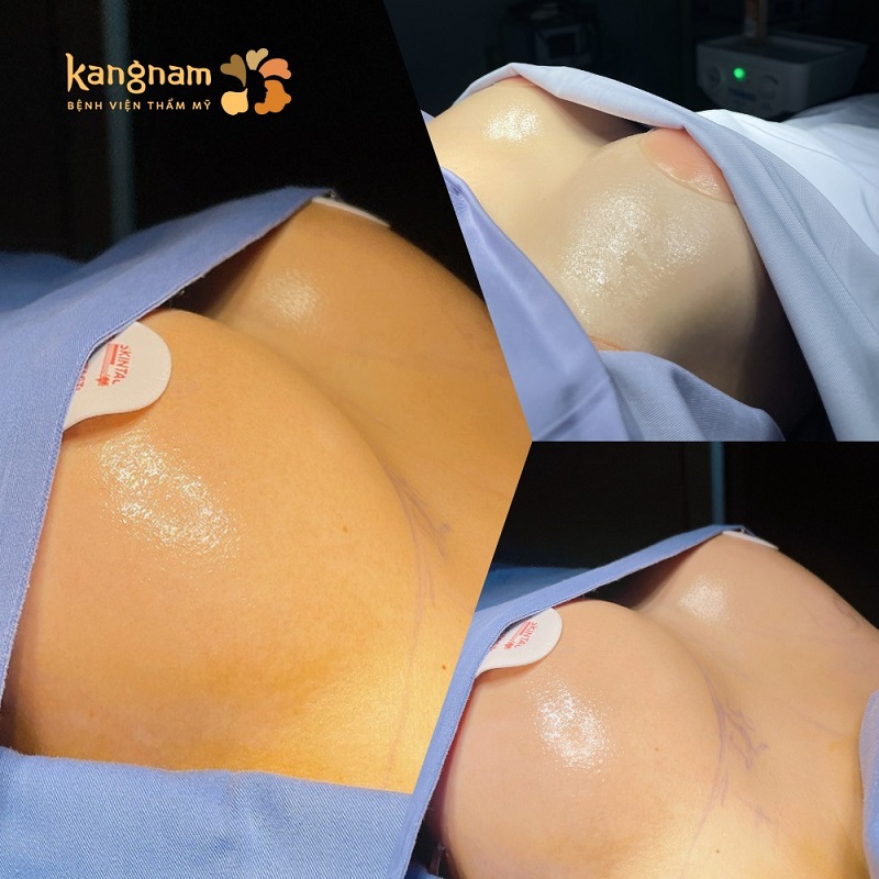 Khách hàng sau khi nâng ngực tại Kangnam