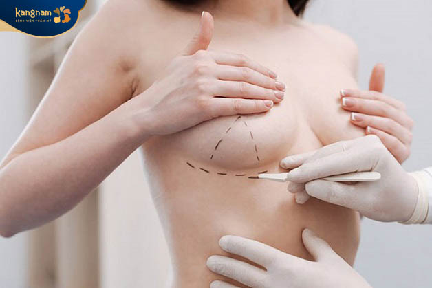 Lần nâng ngực thứ 2 giúp khách hàng có thêm cơ hội lựa chọn phương pháp nâng ngực