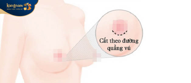 Bác sĩ rạch 1 đường theo quầng vú