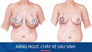 Nâng ngực chảy xệ sau sinh: Bí quyết lấy lại vòng 1 săn chắc sau sinh con