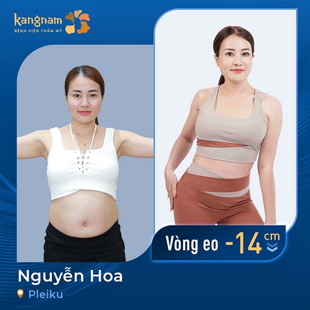 Hút mỡ bụng thường hồi phục hoàn toàn sau khoảng 6 tuần