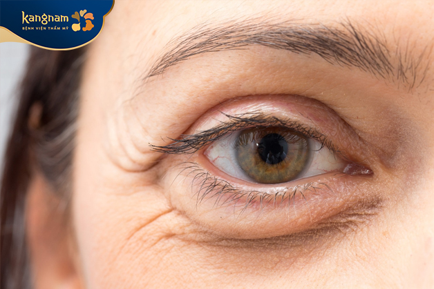 Vùng da dưới mắt theo thời gian sẽ mất đi độ đàn hồi và collagen
