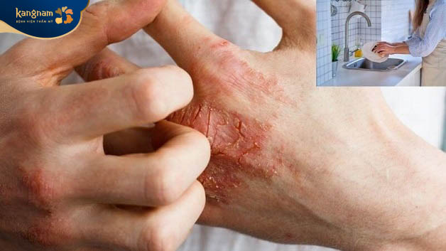 Dị ứng với hóa chất khiến da tay nổi mụn