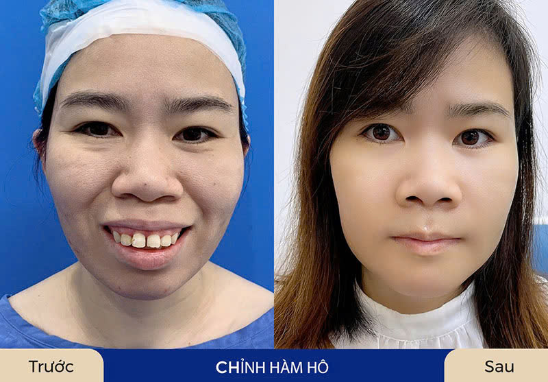 Kết hợp chỉnh hàm hô và cười hở lợi