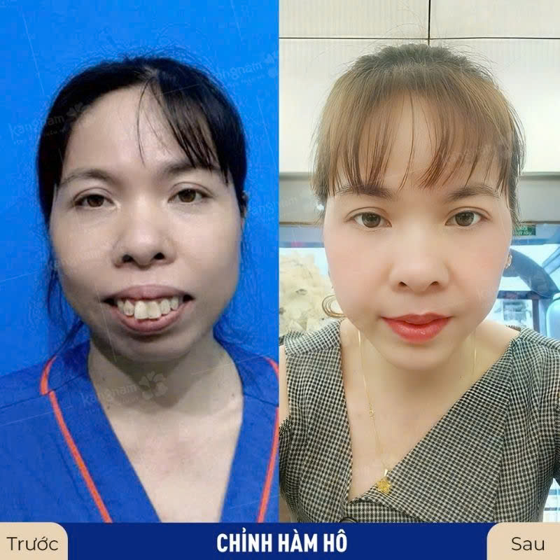 Mức độ phẫu thuật ảnh hưởng tới thời gian lành phẫu thuật hở lợi