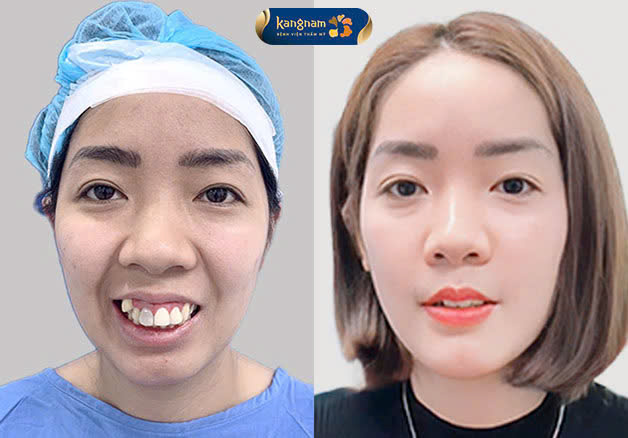 Thời gian lành sau phẫu thuật cười hở lợi phụ thuộc nhiều yếu tố