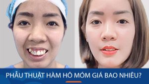 Bảng giá phẫu thuật hàm hô móm mới nhất 2024