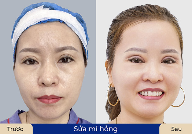 Sửa mí hỏng, lấy lại dáng mí cân đối và tự nhiên