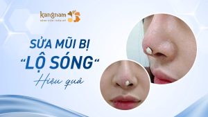 Sửa Mũi Bị Lộ Sóng Hiệu Quả: Bí Quyết Lấy Lại Dáng Mũi Hoàn Hảo