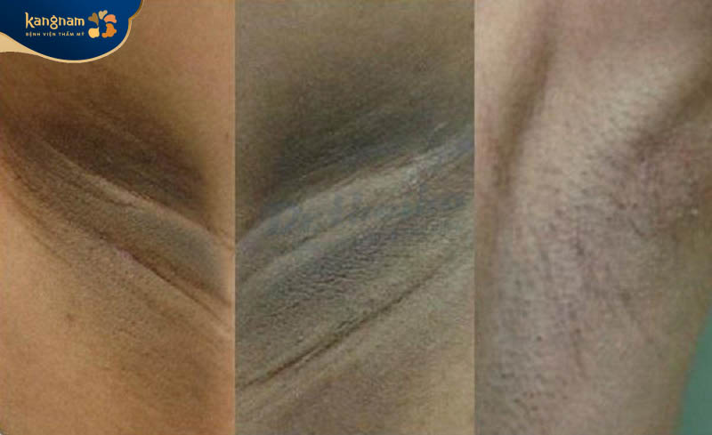 Vùng nách thâm đen, nổi nhiều mụn