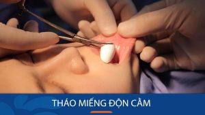 Tháo miếng độn cằm: An toàn, không đau, hồi phục nhanh