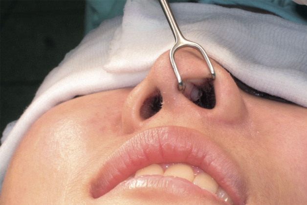 Tháo sụn mũi (1) (gỡ sụn mũi) là kỹ thuật loại bỏ các chất liệu sụn dùng để nâng cao sống mũi