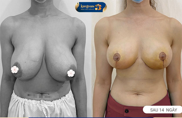 Phẫu thuật treo sa trễ giúp nâng cao và làm săn chắc ngực chảy xệ