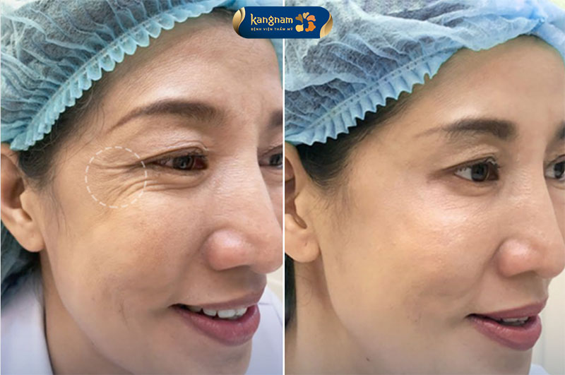 Xóa nhăn đuôi mắt bằng botox