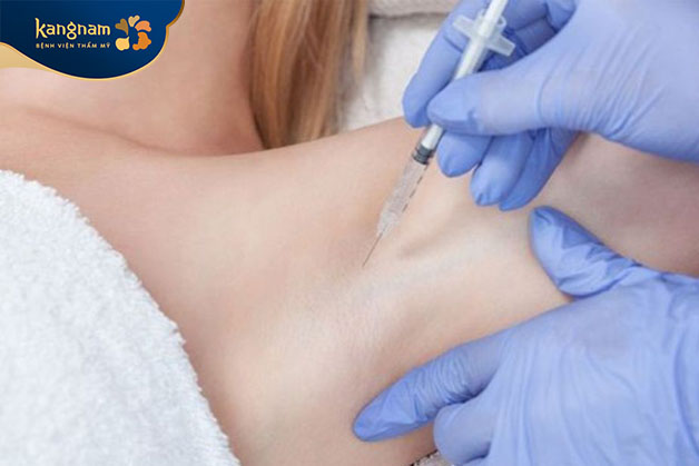 Tiêm trực tiếp botox vào vùng nách