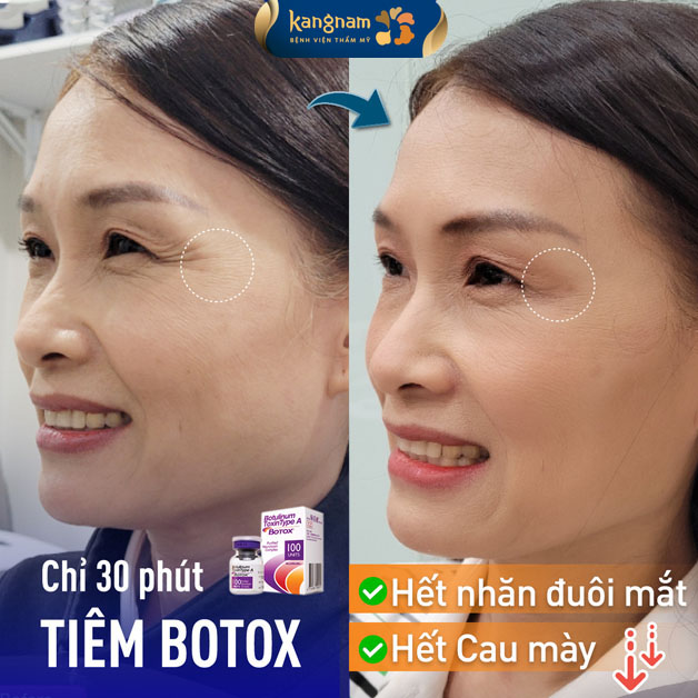 Trẻ hóa vùng mắt sau 30 phút tiêm botox