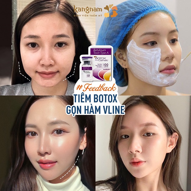 Thu Hằng sở hữu khuôn mặt thon gọn sau khi tiêm Botox tại Kangnam