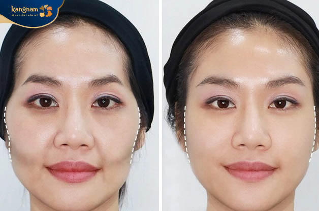 Tiêm filler má bao lâu thì mềm - thực tế sau khoảng 3 - 4 ngày vùng má sẽ dần mềm mại