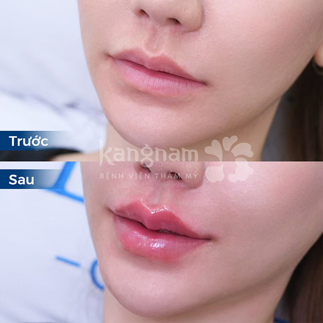 Hiệu quả sau khi tiêm filler giúp môi căng mọng, tự nhiên
