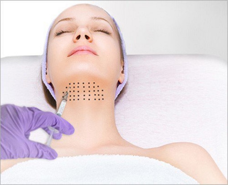 Tiêm tan mỡ nọng cằm không can thiệp xâm lấn