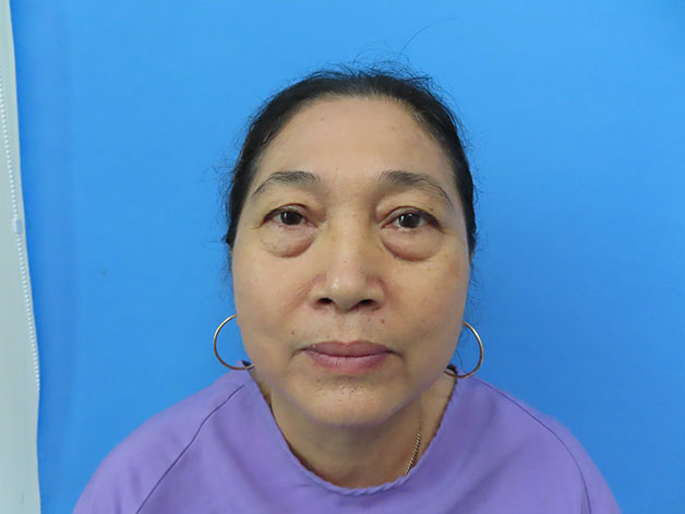 Trường hợp mắt lão hóa nặng, nhiều da chùng